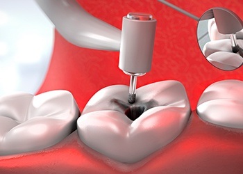 Animatio of root canal therapy