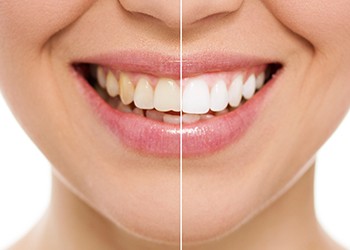 Smiling woman with split view of before and after whitening