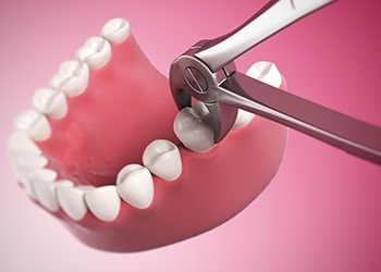 Animatio of tooth extraction