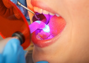Curing light being used in the mouth
