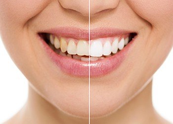 Closeup of smile half before and half after whitening