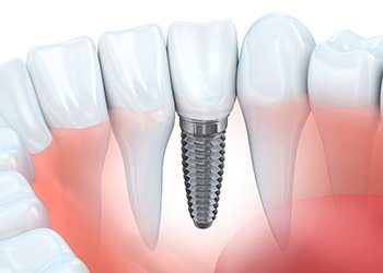 Animation of implant denture