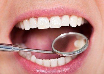 Closeup of beautiful smile during dental exam