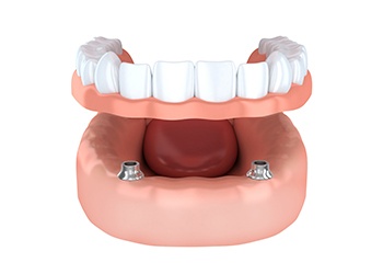 image of denture fitting over implants