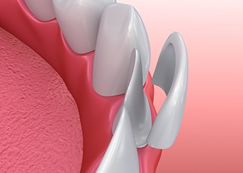 Computer demonstration of a veneer being placed over a prepped tooth