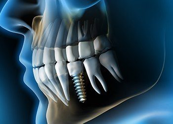 Animation of implant supported dental crown